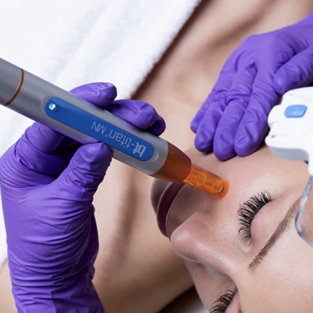 Microneedling with the best Skin Pen BT Titan