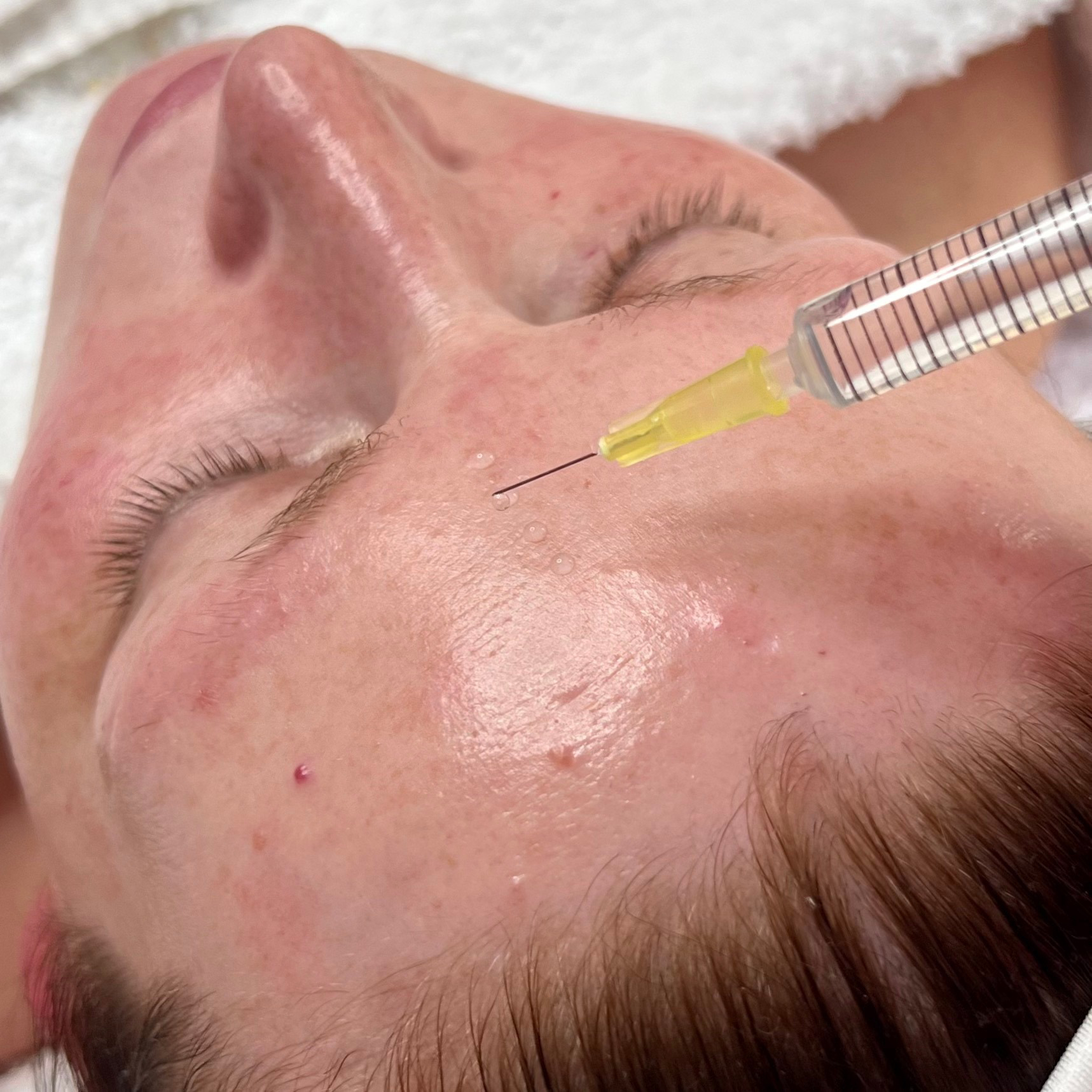 Woman receiving a non-surgical facelift treatment to rejuvenate and tighten her skin for a youthful appearance.