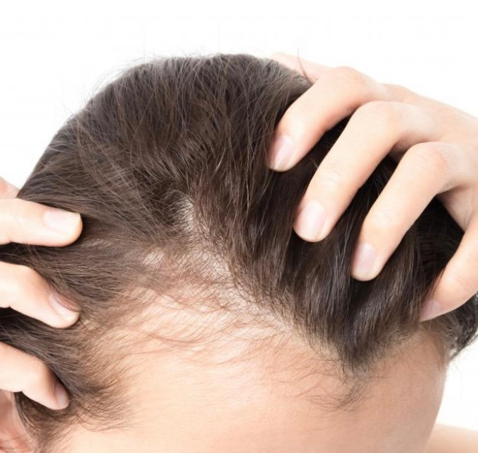 Hair loss treatment in Nottingham