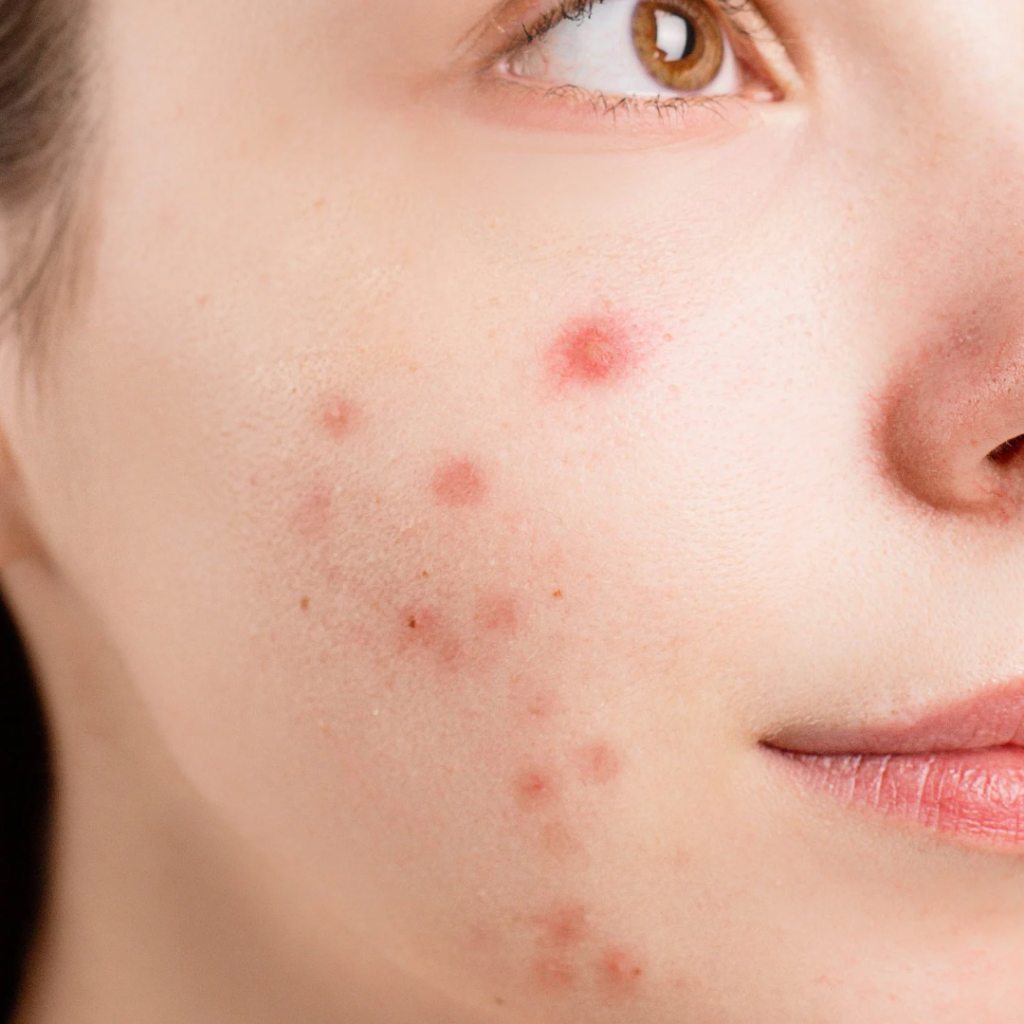 Acne Tips how to treat it