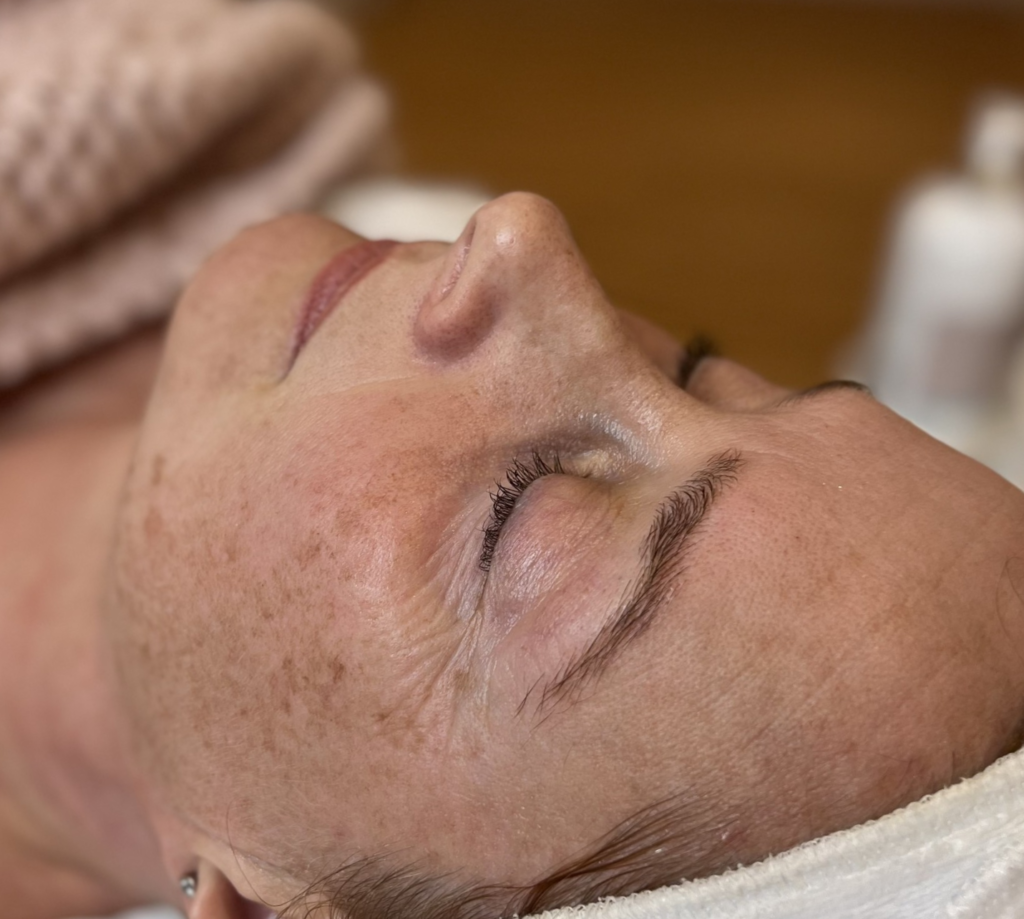 TCA Skin Peel to target dark spots and uneven skin tone.