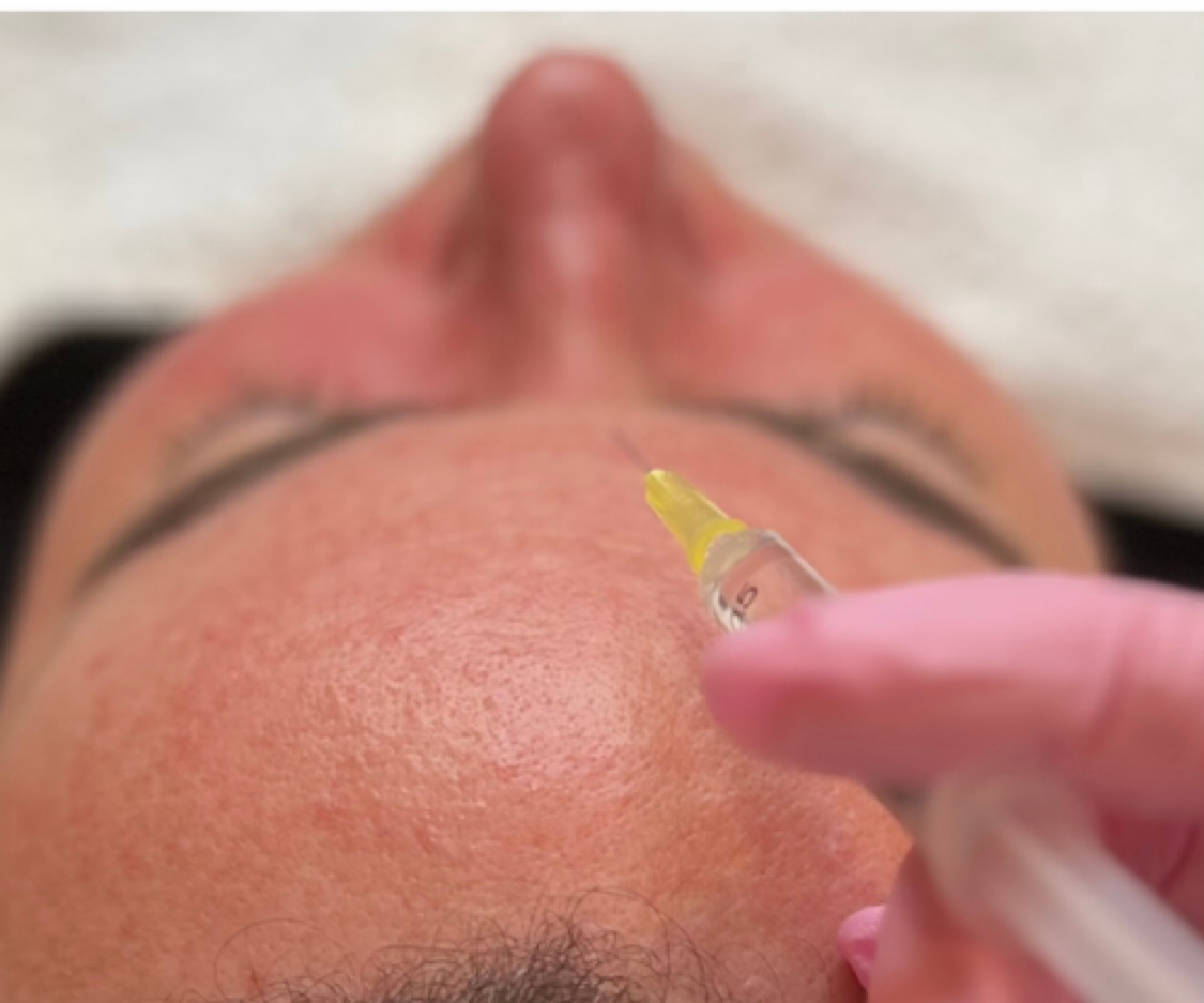 Mesotherapy Face for Skin Rejuvenation in Mapperely
