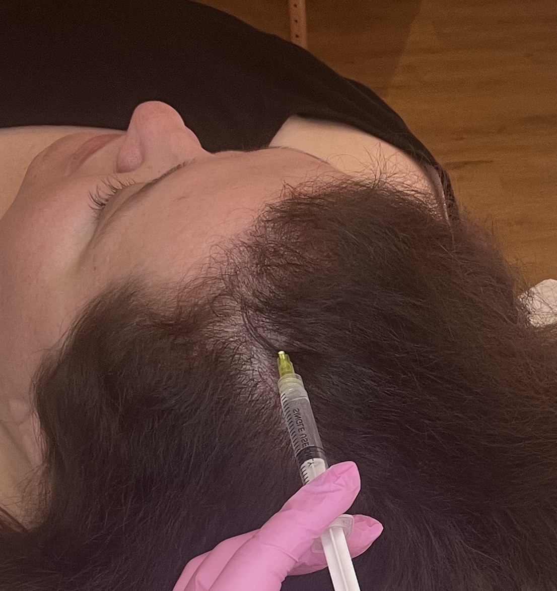 Hair Loss treament with hair booster in Nottingham